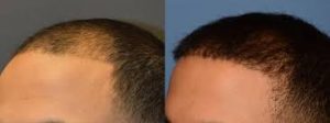 before and after picture of a man's head after PRP treatment from Fountain of You MD